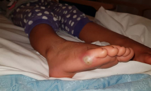 Thomas chia sẻ bức ảnh chụp vết nhiễm trùng ở chân con gái cùng bài viết trên mạng xã hội.