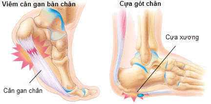 Đau gót chân chủ yếu do viêm cân gan bàn chân